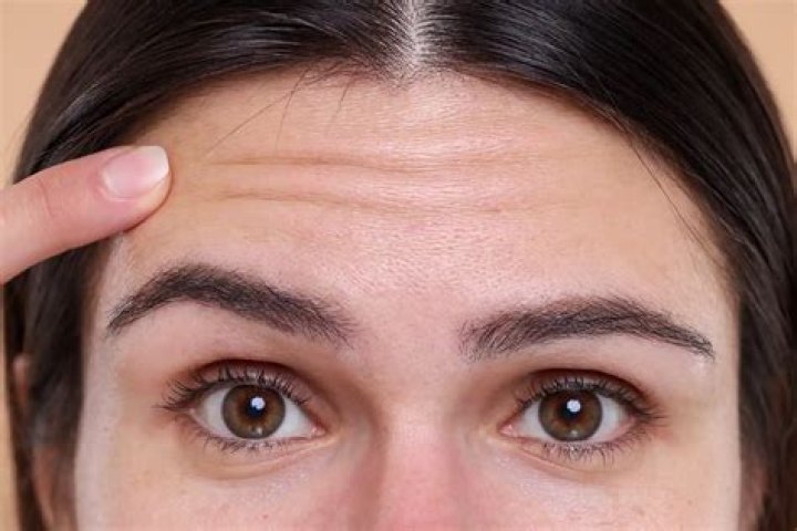 At what age do you get forehead wrinkles?