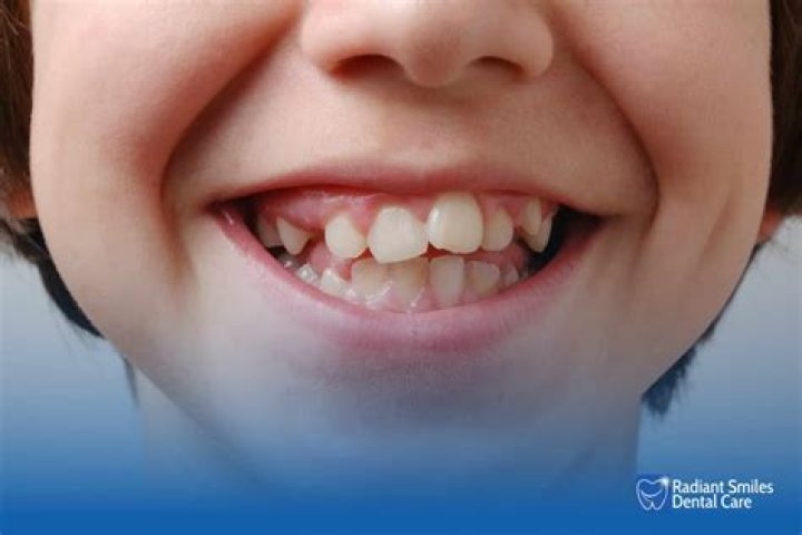 Can losing teeth cause depression?