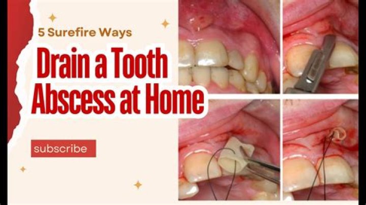 How do you burst an abscess naturally?
