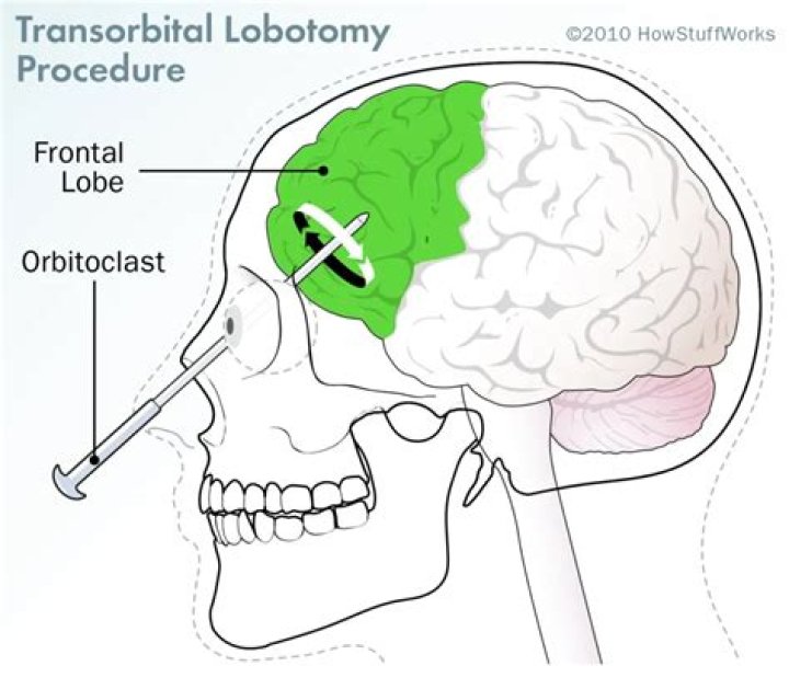 Why were prefrontal lobotomies done?